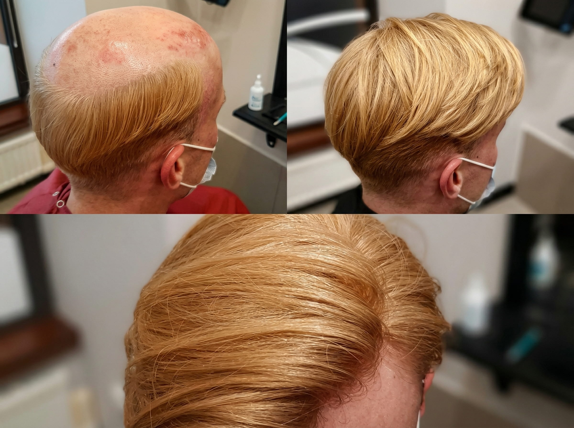 Zestawienie kilku ujęć skóry głowy przed założeniem topperu z&nbsp;widocznymi przerzedzeniami oraz po&nbsp;jego przypięciu, z&nbsp;pełną i&nbsp;gęstą fryzurą.